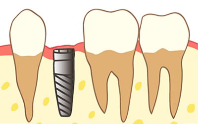 2回法のインプラント治療を行っております